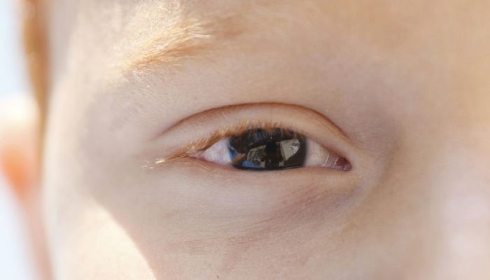 Diagnóstico precoce da baixa visão infantil é crucial para o desenvolvimento